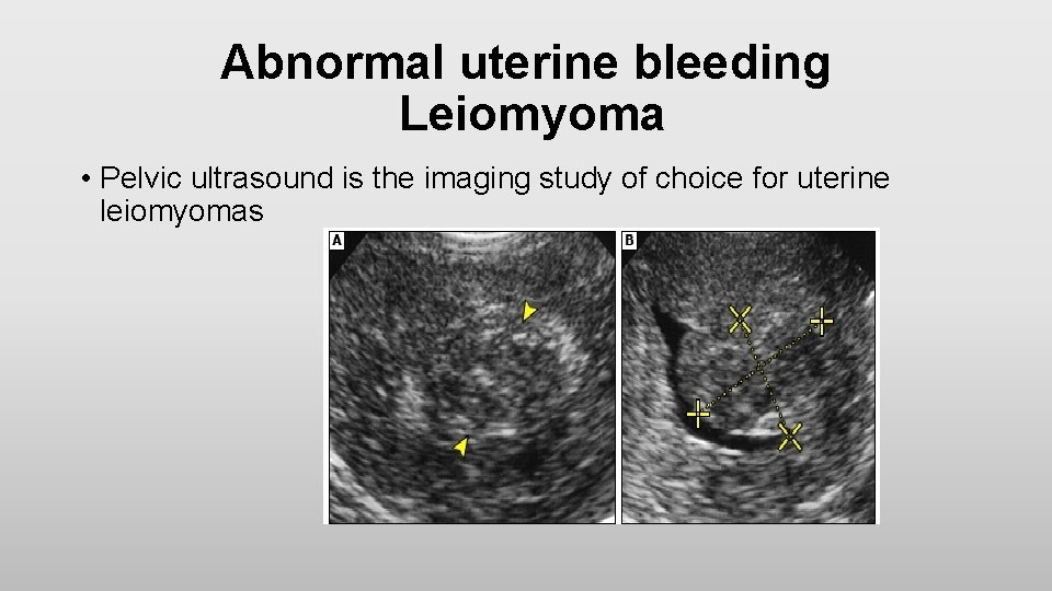 Abnormal uterine bleeding Leiomyoma • Pelvic ultrasound is the imaging study of choice for