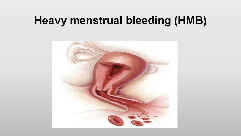 Heavy menstrual bleeding (HMB) 