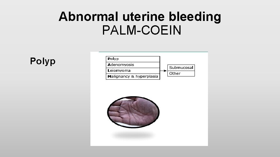 Abnormal uterine bleeding PALM-COEIN Polyp 