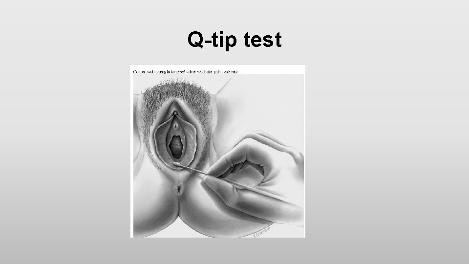 Q-tip test 