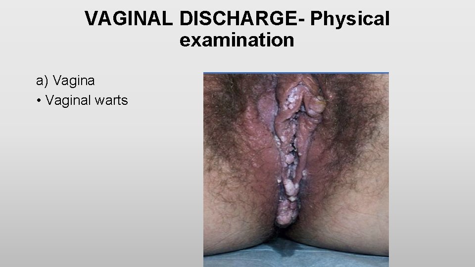 VAGINAL DISCHARGE- Physical examination a) Vagina • Vaginal warts 