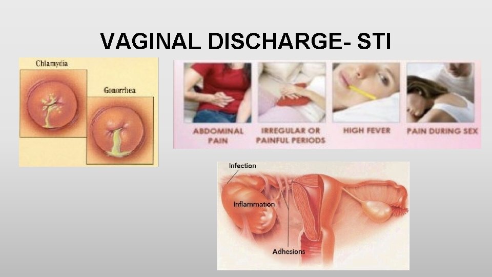 VAGINAL DISCHARGE- STI • Diagnosis 