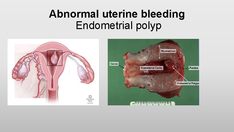 Abnormal uterine bleeding Endometrial polyp 