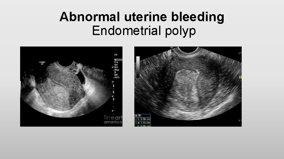 Abnormal uterine bleeding Endometrial polyp 