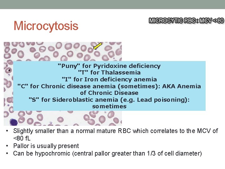 Microcytosis "Puny" for Pyridoxine deficiency "T" for Thalassemia "I" for Iron deficiency anemia "C" Microcytosis "Puny" for Pyridoxine deficiency "T" for Thalassemia "I" for Iron deficiency anemia "C"