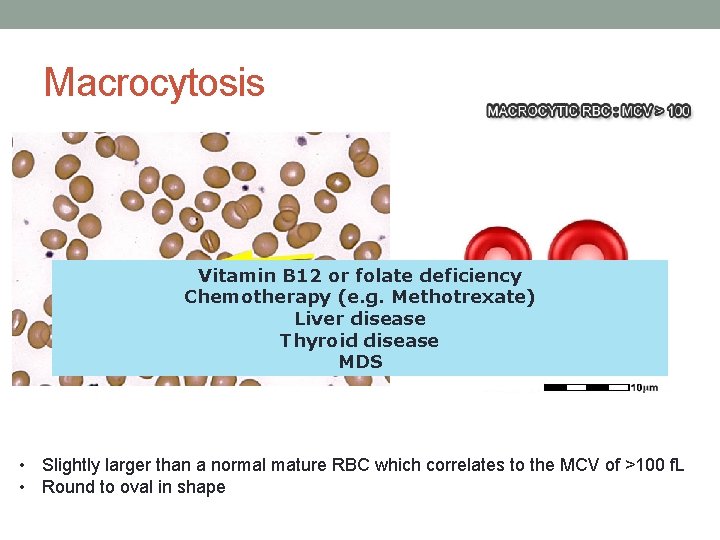 Macrocytosis Vitamin B 12 or folate deficiency Chemotherapy (e. g. Methotrexate) Liver disease Thyroid Macrocytosis Vitamin B 12 or folate deficiency Chemotherapy (e. g. Methotrexate) Liver disease Thyroid