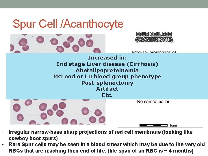 Spur Cell /Acanthocyte Increased in: End stage Liver disease (Cirrhosis) Abetalipoproteinemia Mc. Leod or Spur Cell /Acanthocyte Increased in: End stage Liver disease (Cirrhosis) Abetalipoproteinemia Mc. Leod or