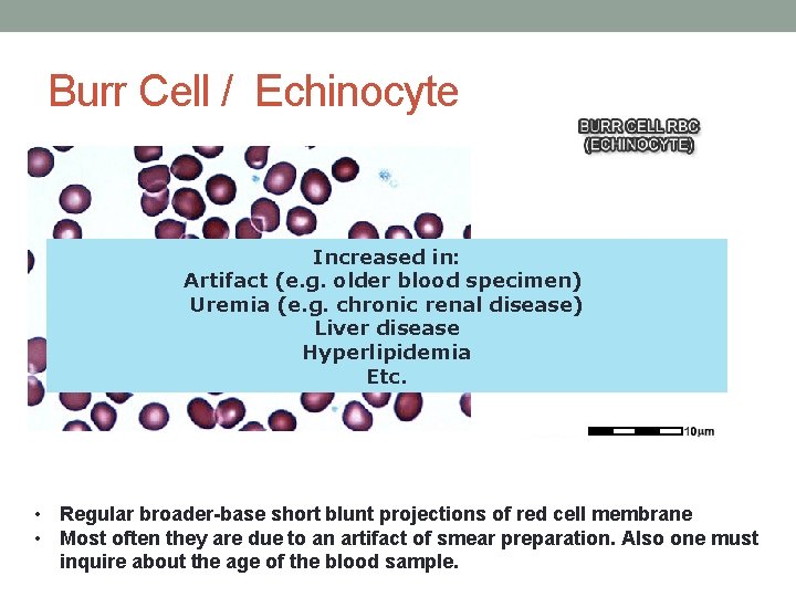 Burr Cell / Echinocyte Increased in: Artifact (e. g. older blood specimen) Uremia (e. Burr Cell / Echinocyte Increased in: Artifact (e. g. older blood specimen) Uremia (e.