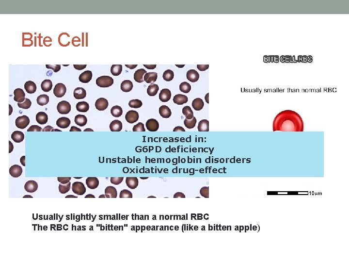 Bite Cell Increased in: G 6 PD deficiency Unstable hemoglobin disorders Oxidative drug-effect Usually Bite Cell Increased in: G 6 PD deficiency Unstable hemoglobin disorders Oxidative drug-effect Usually