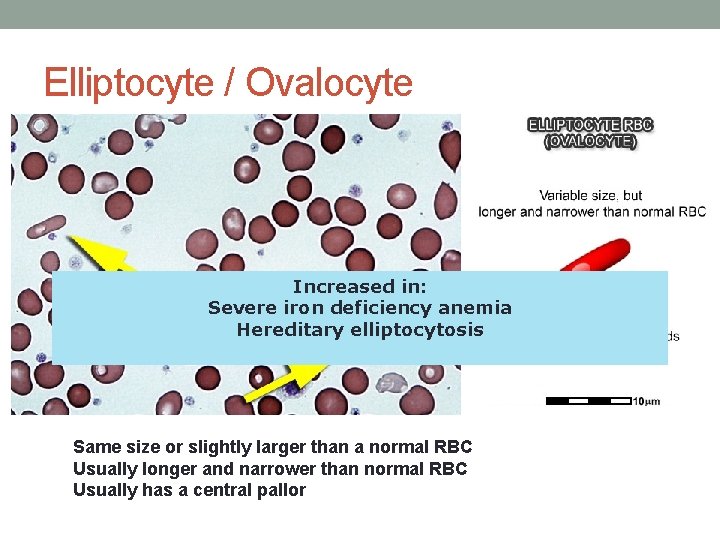 Elliptocyte / Ovalocyte Increased in: Severe iron deficiency anemia Hereditary elliptocytosis Same size or Elliptocyte / Ovalocyte Increased in: Severe iron deficiency anemia Hereditary elliptocytosis Same size or