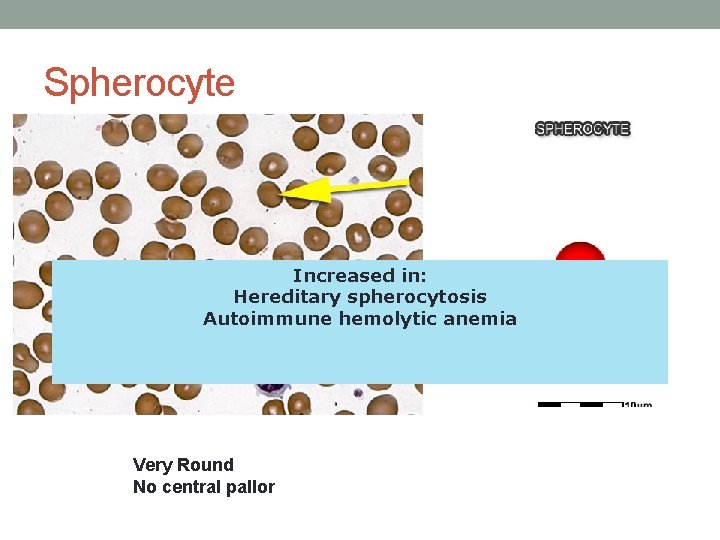 Spherocyte Increased in: Hereditary spherocytosis Autoimmune hemolytic anemia Very Round No central pallor  Spherocyte Increased in: Hereditary spherocytosis Autoimmune hemolytic anemia Very Round No central pallor