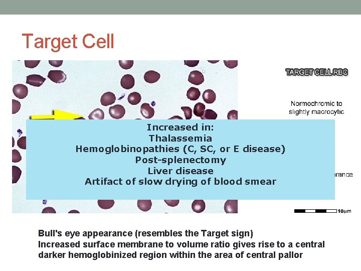 Target Cell Increased in: Thalassemia Hemoglobinopathies (C, SC, or E disease) Post-splenectomy Liver disease Target Cell Increased in: Thalassemia Hemoglobinopathies (C, SC, or E disease) Post-splenectomy Liver disease