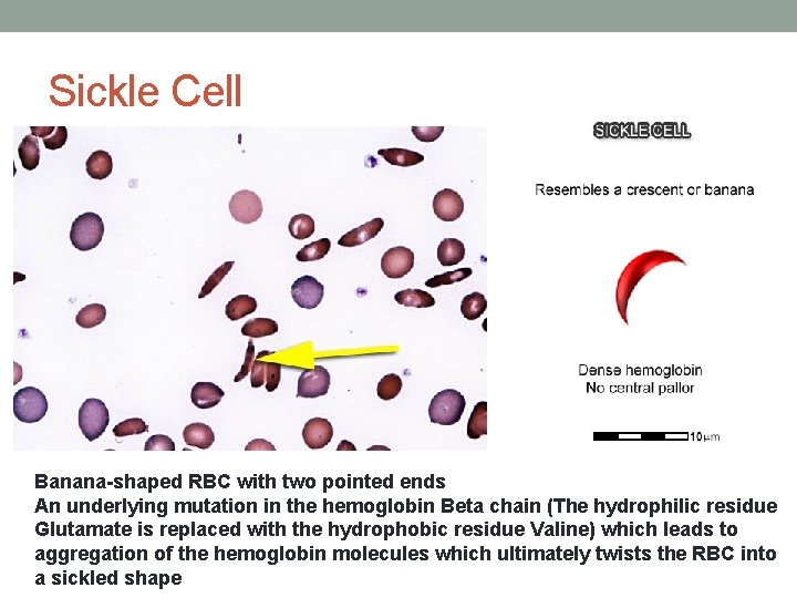 Sickle Cell Banana-shaped RBC with two pointed ends An underlying mutation in the hemoglobin Sickle Cell Banana-shaped RBC with two pointed ends An underlying mutation in the hemoglobin