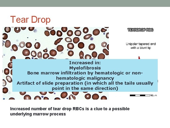 Tear Drop • Increased number of tear drop RBCs is a clue to a Tear Drop • Increased number of tear drop RBCs is a clue to a