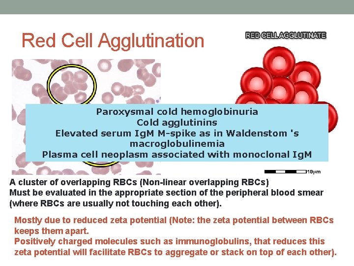 Red Cell Agglutination Paroxysmal cold hemoglobinuria Cold agglutinins Elevated serum Ig. M M-spike as Red Cell Agglutination Paroxysmal cold hemoglobinuria Cold agglutinins Elevated serum Ig. M M-spike as