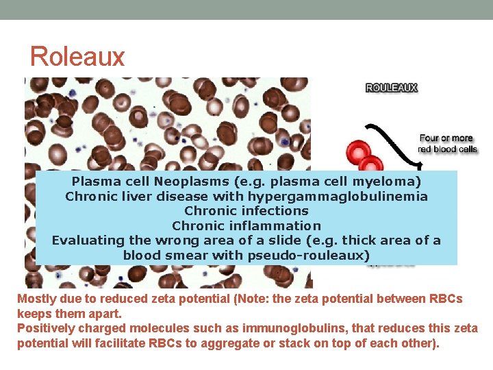 Roleaux Plasma cell Neoplasms (e. g. plasma cell myeloma) Chronic liver disease with hypergammaglobulinemia Roleaux Plasma cell Neoplasms (e. g. plasma cell myeloma) Chronic liver disease with hypergammaglobulinemia