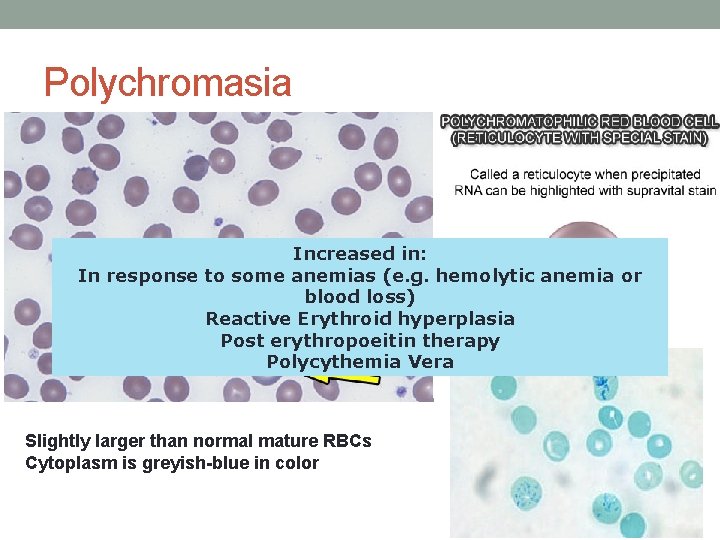 Polychromasia Increased in: In response to some anemias (e. g. hemolytic anemia or blood Polychromasia Increased in: In response to some anemias (e. g. hemolytic anemia or blood