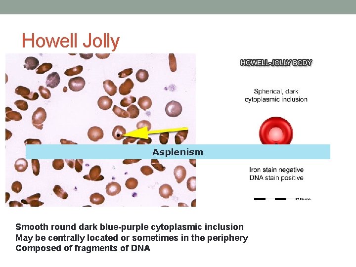 Howell Jolly Asplenism Smooth round dark blue-purple cytoplasmic inclusion May be centrally located or Howell Jolly Asplenism Smooth round dark blue-purple cytoplasmic inclusion May be centrally located or