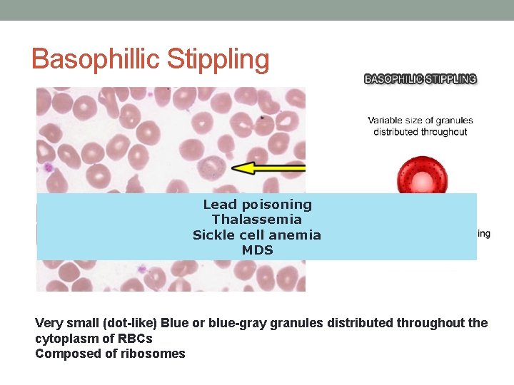 Basophillic Stippling Lead poisoning Thalassemia Sickle cell anemia MDS Very small (dot-like) Blue or Basophillic Stippling Lead poisoning Thalassemia Sickle cell anemia MDS Very small (dot-like) Blue or