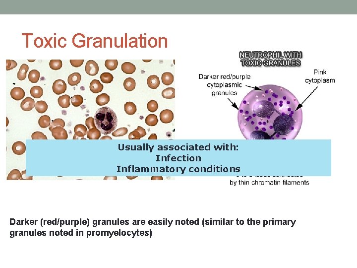 Toxic Granulation Usually associated with: Infection Inflammatory conditions Darker (red/purple) granules are easily noted Toxic Granulation Usually associated with: Infection Inflammatory conditions Darker (red/purple) granules are easily noted