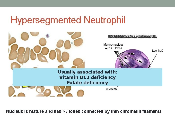 Hypersegmented Neutrophil Usually associated with: Vitamin B 12 deficiency Folate deficiency Nucleus is mature Hypersegmented Neutrophil Usually associated with: Vitamin B 12 deficiency Folate deficiency Nucleus is mature