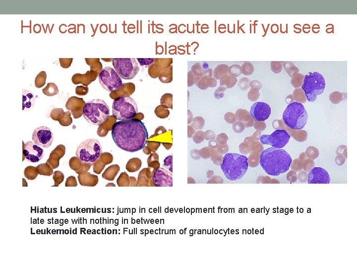 How can you tell its acute leuk if you see a blast? Hiatus Leukemicus: How can you tell its acute leuk if you see a blast? Hiatus Leukemicus: