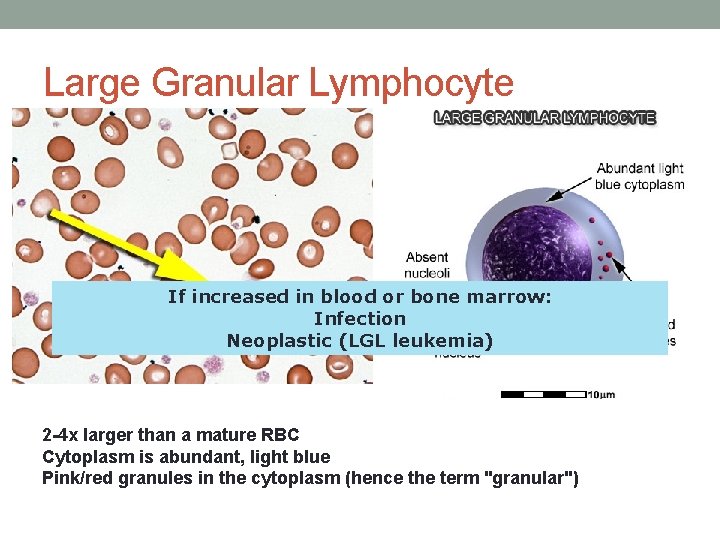 Large Granular Lymphocyte If increased in blood or bone marrow: Infection Neoplastic (LGL leukemia) Large Granular Lymphocyte If increased in blood or bone marrow: Infection Neoplastic (LGL leukemia)
