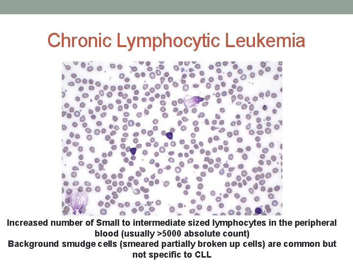 Chronic Lymphocytic Leukemia Increased number of Small to intermediate sized lymphocytes in the peripheral Chronic Lymphocytic Leukemia Increased number of Small to intermediate sized lymphocytes in the peripheral