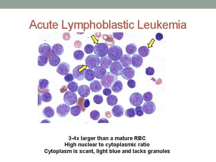 Acute Lymphoblastic Leukemia 3 -4 x larger than a mature RBC High nuclear to Acute Lymphoblastic Leukemia 3 -4 x larger than a mature RBC High nuclear to