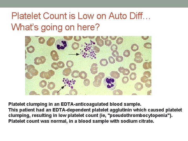 Platelet Count is Low on Auto Diff… What’s going on here? Platelet clumping in Platelet Count is Low on Auto Diff… What’s going on here? Platelet clumping in