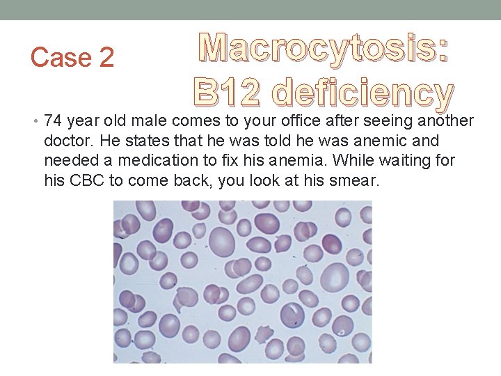 Case 2 Macrocytosis: B 12 deficiency • 74 year old male comes to your Case 2 Macrocytosis: B 12 deficiency • 74 year old male comes to your