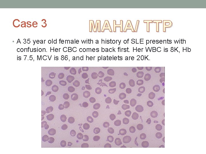 Case 3 MAHA/ TTP • A 35 year old female with a history of Case 3 MAHA/ TTP • A 35 year old female with a history of