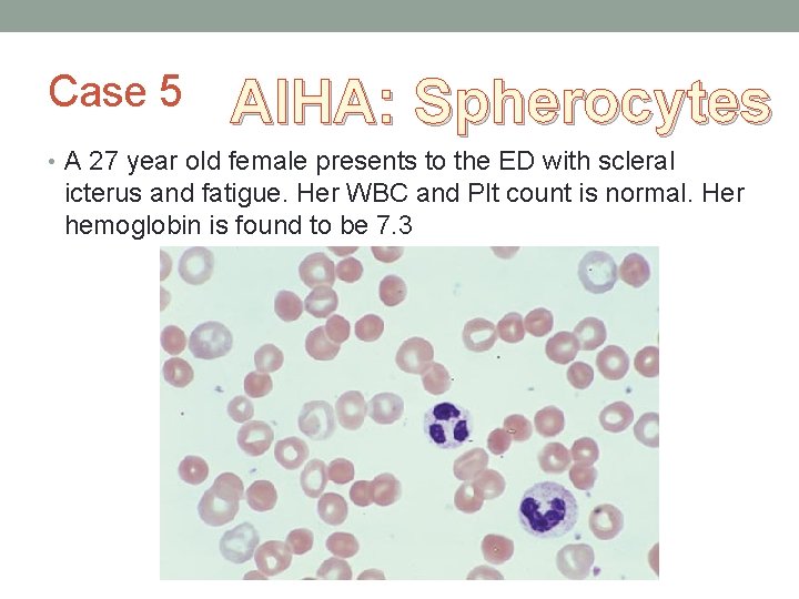 Case 5 AIHA: Spherocytes • A 27 year old female presents to the ED Case 5 AIHA: Spherocytes • A 27 year old female presents to the ED