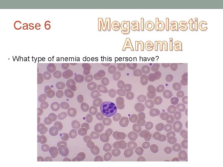 Case 6 Megaloblastic Anemia • What type of anemia does this person have?  Case 6 Megaloblastic Anemia • What type of anemia does this person have?