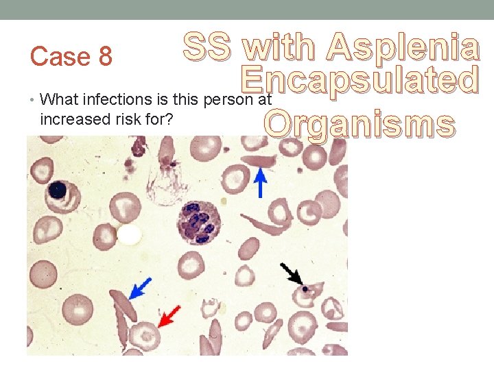 SS with Asplenia Encapsulated What infections is this person at increased risk for? Organisms SS with Asplenia Encapsulated What infections is this person at increased risk for? Organisms