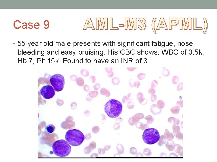 Case 9 AML-M 3 (APML) • 55 year old male presents with significant fatigue, Case 9 AML-M 3 (APML) • 55 year old male presents with significant fatigue,