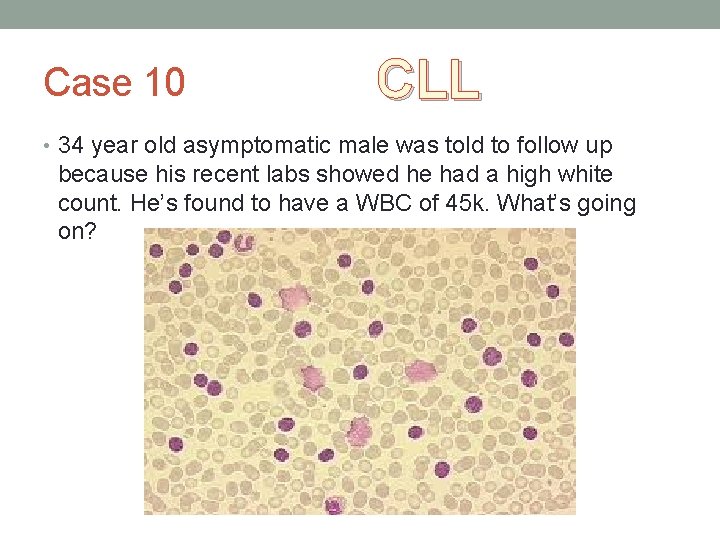 Case 10 CLL • 34 year old asymptomatic male was told to follow up Case 10 CLL • 34 year old asymptomatic male was told to follow up