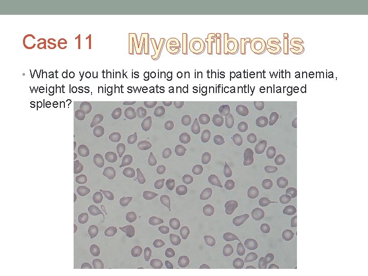 Case 11 Myelofibrosis • What do you think is going on in this patient Case 11 Myelofibrosis • What do you think is going on in this patient