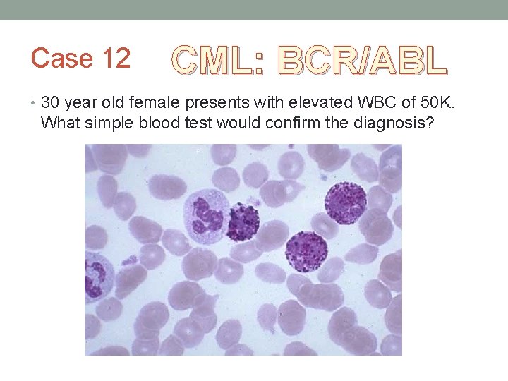 Case 12 CML: BCR/ABL • 30 year old female presents with elevated WBC of Case 12 CML: BCR/ABL • 30 year old female presents with elevated WBC of