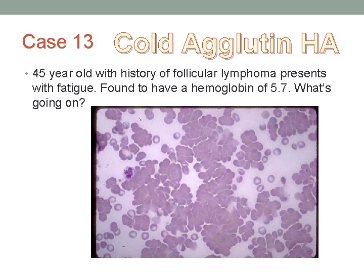 Case 13 Cold Agglutin HA • 45 year old with history of follicular lymphoma Case 13 Cold Agglutin HA • 45 year old with history of follicular lymphoma