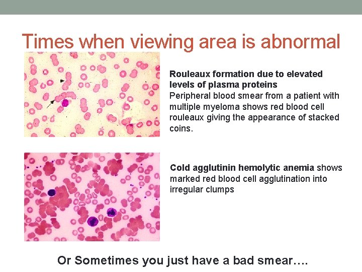 Times when viewing area is abnormal Rouleaux formation due to elevated levels of plasma Times when viewing area is abnormal Rouleaux formation due to elevated levels of plasma