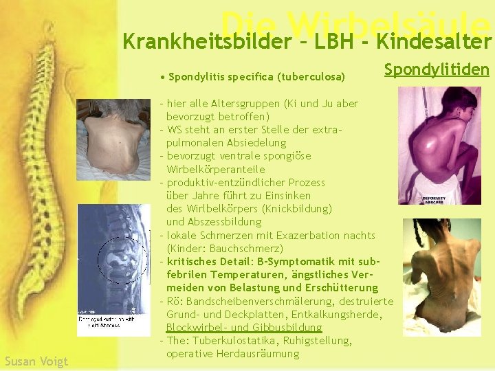 Die Wirbelsäule Krankheitsbilder – LBH - Kindesalter • Spondylitis specifica (tuberculosa) Susan Voigt Spondylitiden