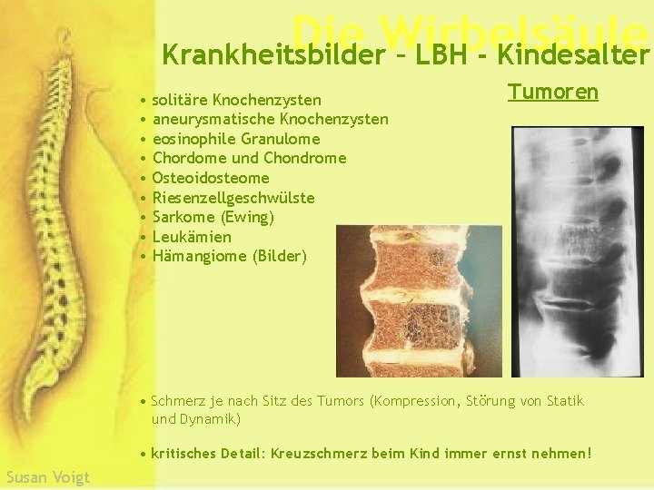 Die Wirbelsäule Krankheitsbilder – LBH - Kindesalter • solitäre Knochenzysten • aneurysmatische Knochenzysten •