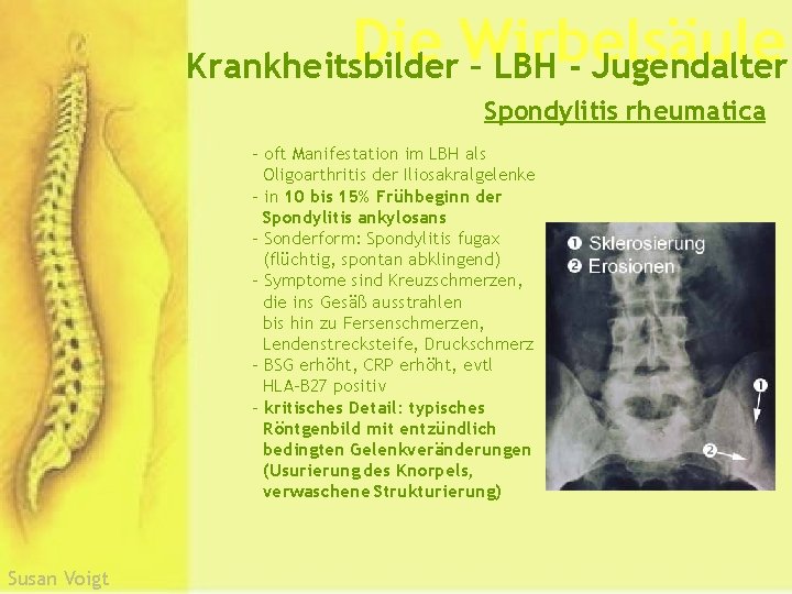 Die Wirbelsäule Krankheitsbilder – LBH - Jugendalter Spondylitis rheumatica - oft Manifestation im LBH