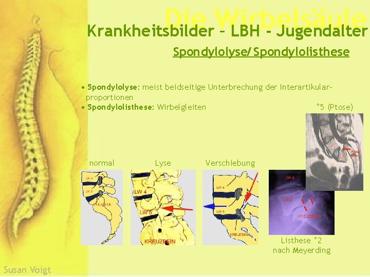 Die Wirbelsäule Krankheitsbilder – LBH - Jugendalter Spondylolyse/ Spondylolisthese • Spondylolyse: meist beidseitige Unterbrechung