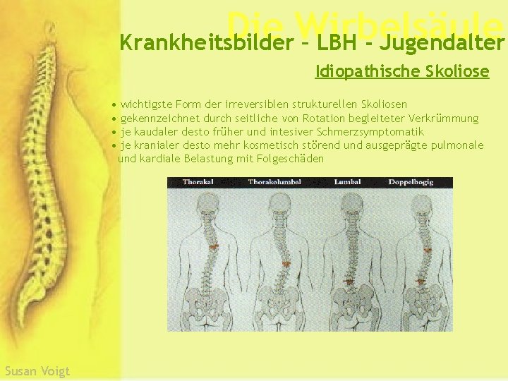 Die Wirbelsäule Krankheitsbilder – LBH - Jugendalter Idiopathische Skoliose • wichtigste Form der irreversiblen