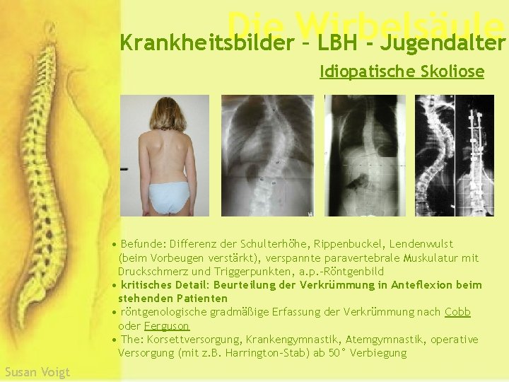 Die Wirbelsäule Krankheitsbilder – LBH - Jugendalter Idiopatische Skoliose • Befunde: Differenz der Schulterhöhe,