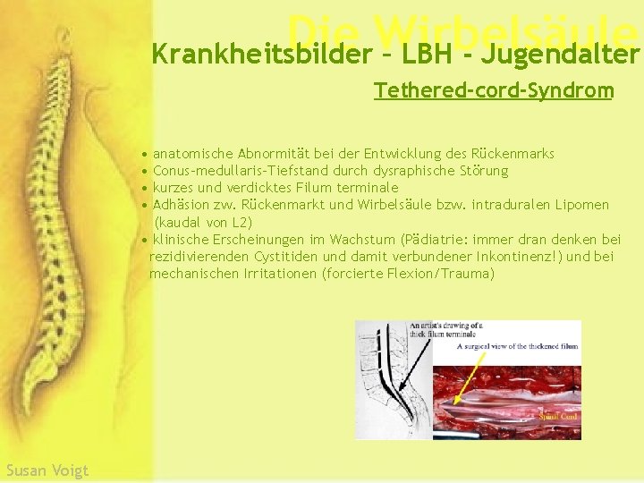 Die Wirbelsäule Krankheitsbilder – LBH - Jugendalter Tethered-cord-Syndrom • anatomische Abnormität bei der Entwicklung