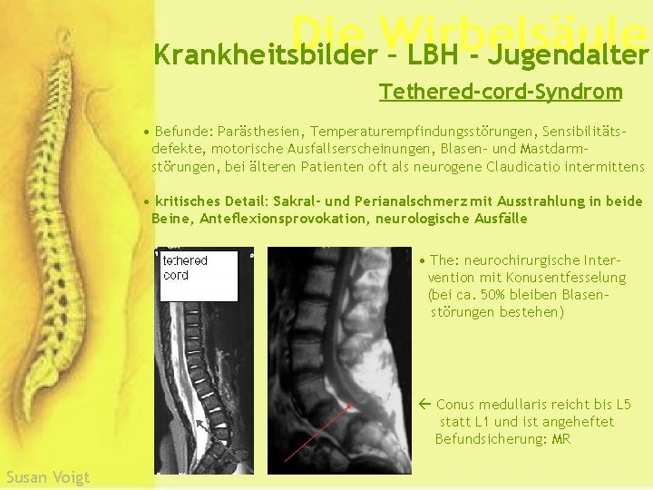 Die Wirbelsäule Krankheitsbilder – LBH - Jugendalter Tethered-cord-Syndrom • Befunde: Parästhesien, Temperaturempfindungsstörungen, Sensibilitätsdefekte, motorische