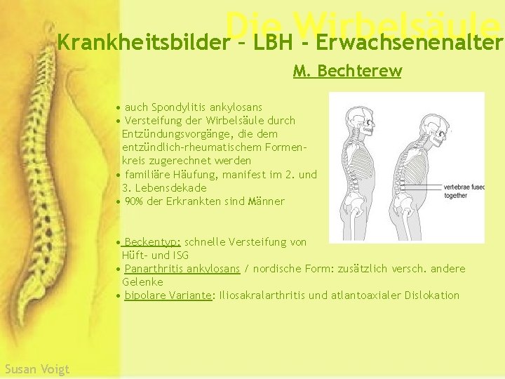Die Wirbelsäule Krankheitsbilder – LBH - Erwachsenenalter M. Bechterew • auch Spondylitis ankylosans •
